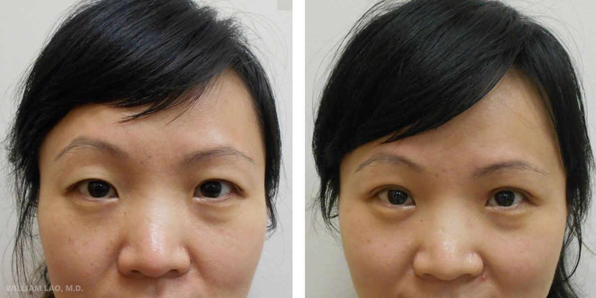 double eyelid surgery new york