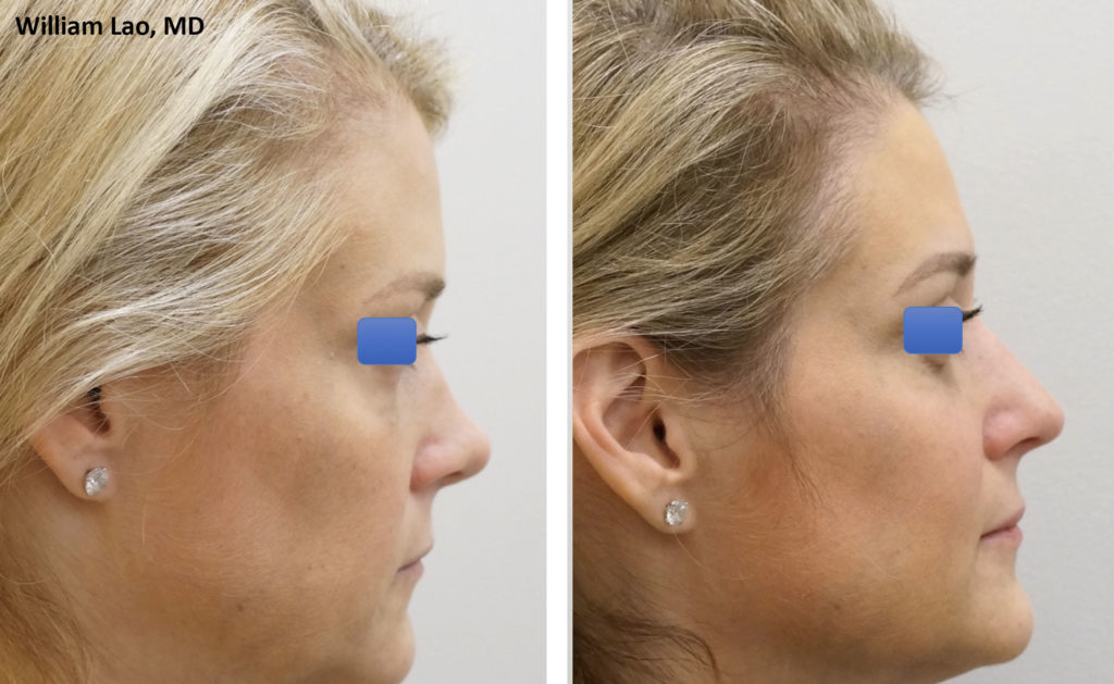 Real patient #2 Rhinoplasty before and after photo