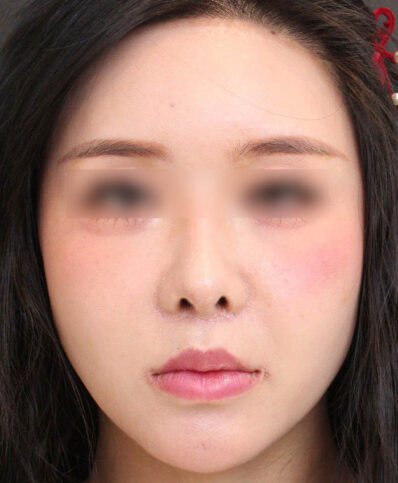 Real patient after facelift photo