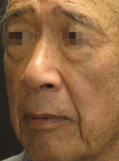 Real patient after facelift photo