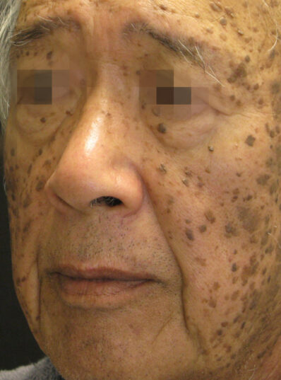 Real patient before facelift photo